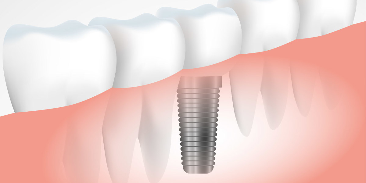 Vidéo pédagogique sur les implants dentaires